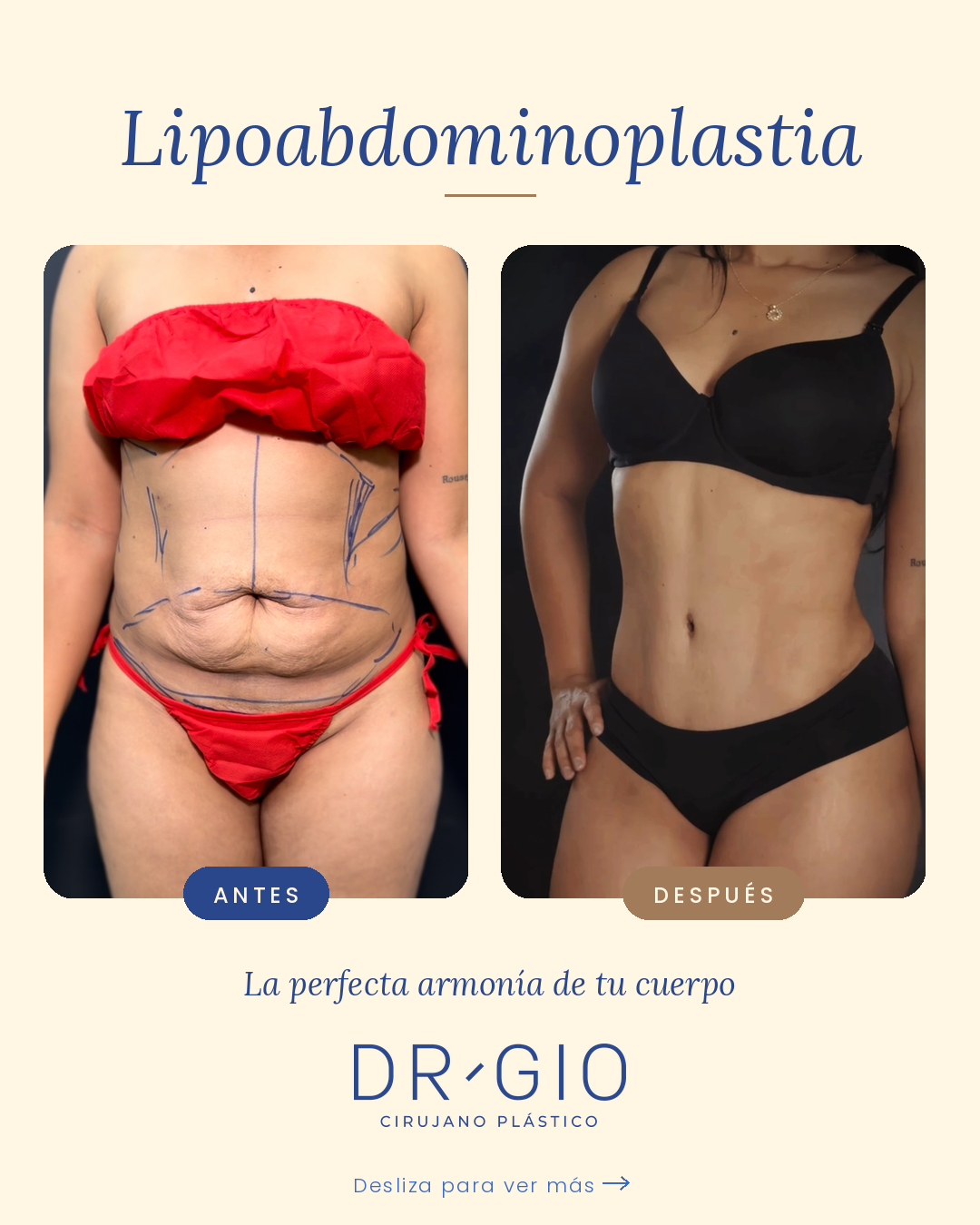 Lipoabdominoplastia