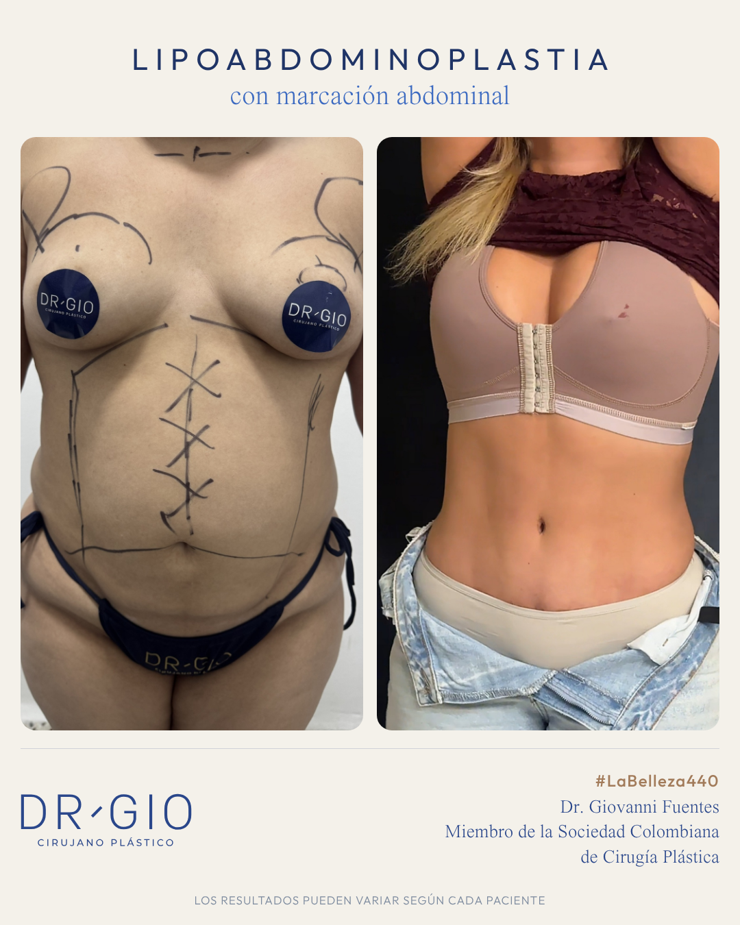 Lipoabdominoplastia marcación abdominal
